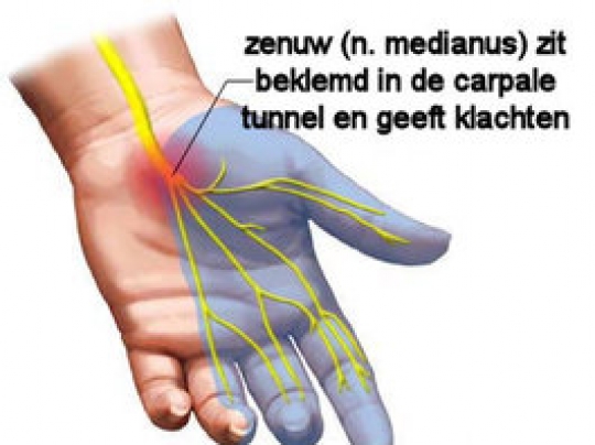Foto bij Polsklachten (o.a. Carpaal Tunnel Syndroom)