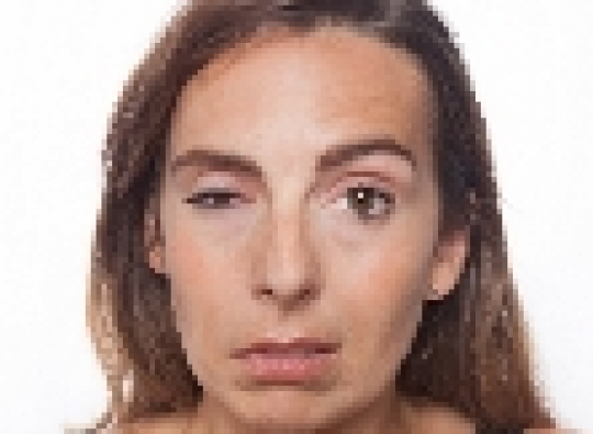 Foto bij Aangezichtsverlamming Foto bij Aangezichtsverlamming