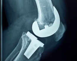 Afbeelding bij: Nieuwe knie