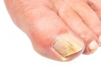 Afbeelding bij Deelbehandeling Mycose (schimmel) nagel 